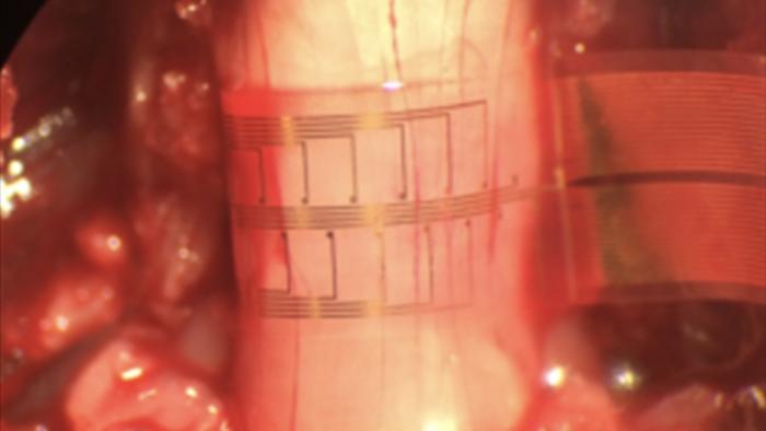 Implant wrapped around a nerve